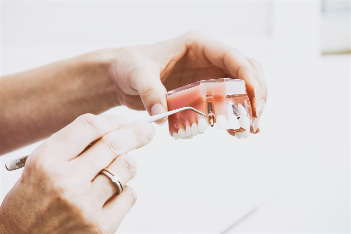 Model zubního implantátu v čelisti